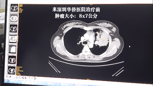 1679993656824391.png 0X肿瘤大小-来院前.png