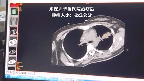 1679993677701502.png 0X肿瘤大小-来院后.png